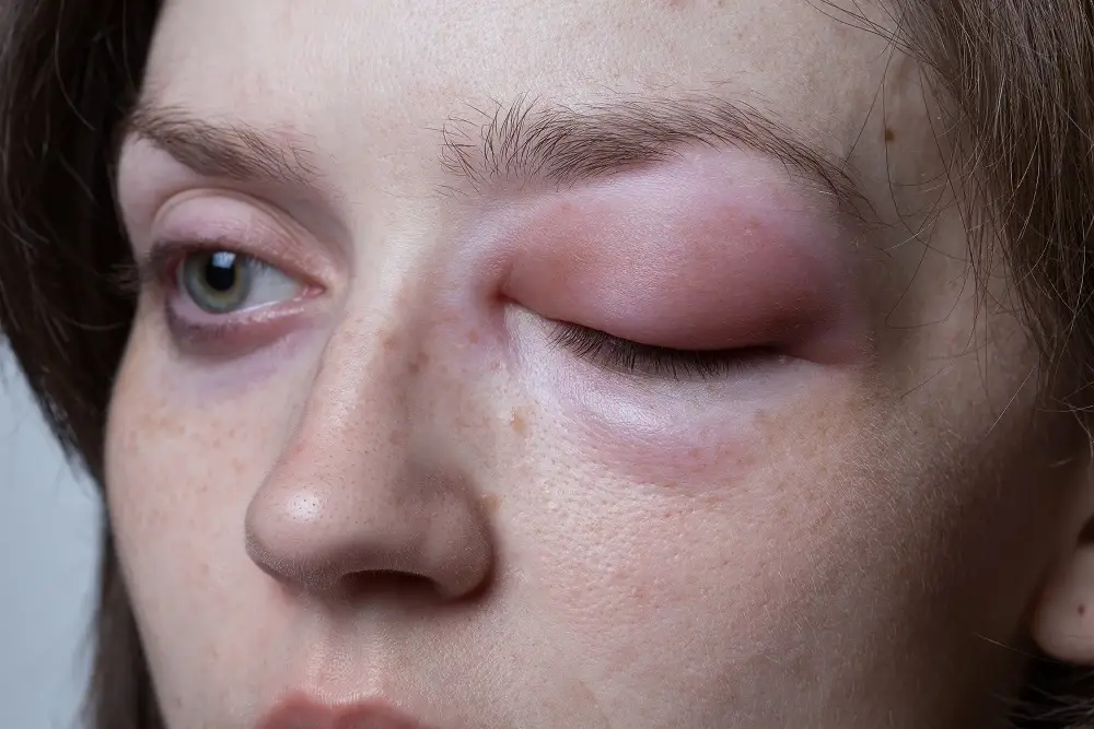 Get Angioedema Treatment From Specialist in Alexandria, VA and Washington DC
