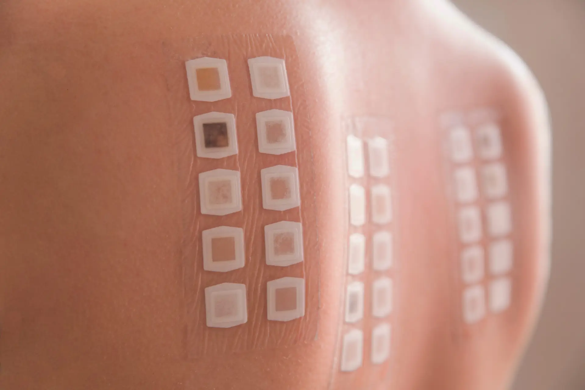Patch Testing