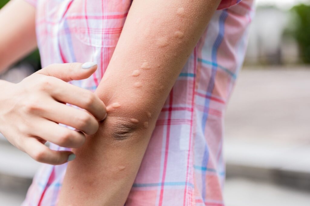 what causes hives